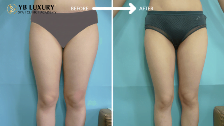 Phương pháp giảm mỡ toàn thân HIỆU QUẢ không phẫu thuật 21 1 768x432