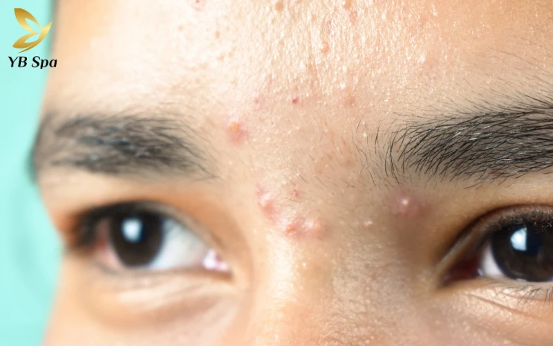 Loại da và tình trạng mụn thực tế