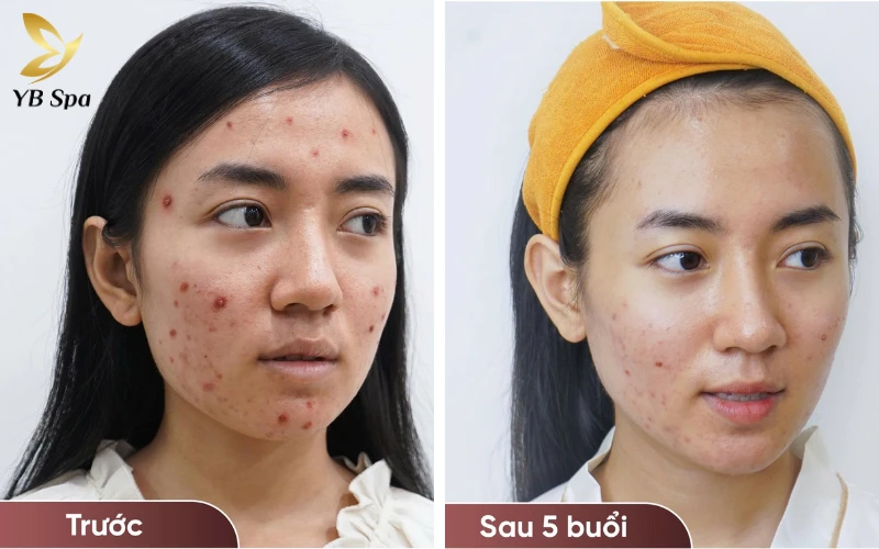 trị mụn tại spa bao nhiêu tiền