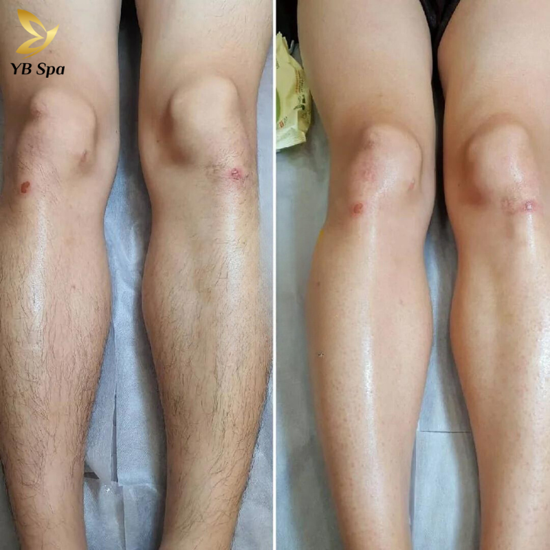 Triệt lông chân HIỆU QUẢ với công nghệ SHR ICE2 tối tân