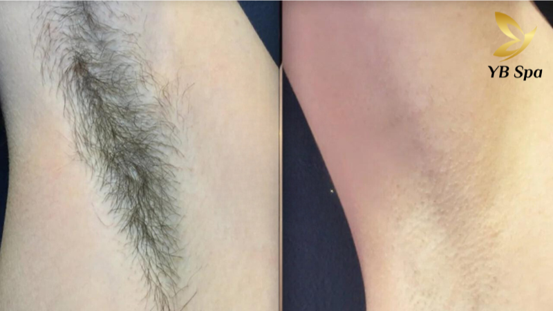 Dịch vụ triệt lông nách UY TÍN công nghệ hiện đại tại YBspa