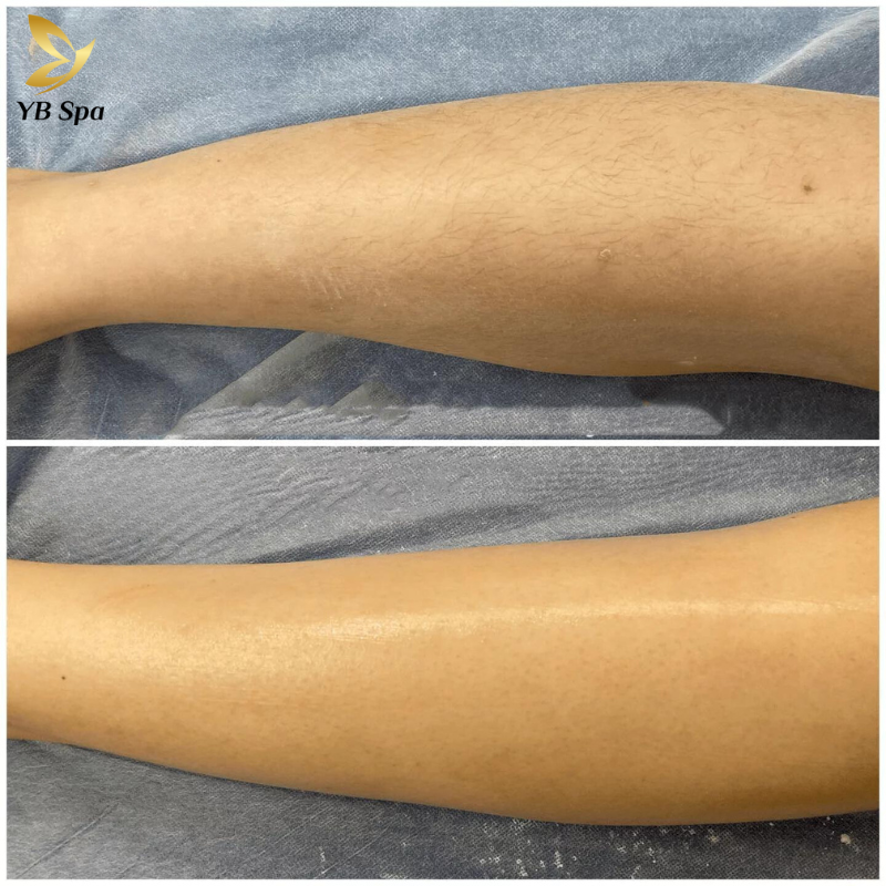 Triệt lông chân HIỆU QUẢ với công nghệ SHR ICE2 tối tân