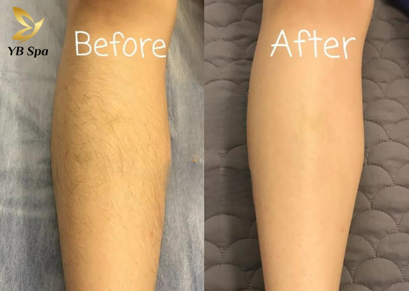 Triệt lông chân HIỆU QUẢ với công nghệ SHR ICE2 tối tân