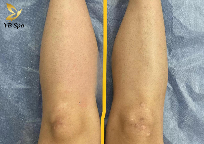 Triệt lông chân HIỆU QUẢ với công nghệ SHR ICE2 tối tân