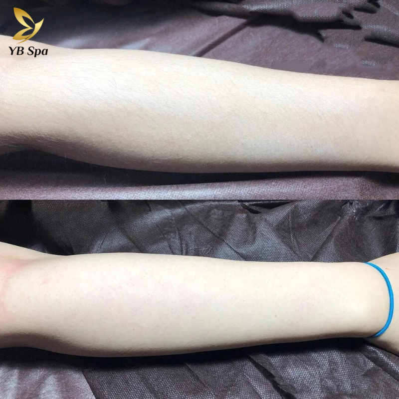 Triệt lông vùng tay AN TOÀN với công nghệ SHR ICE2