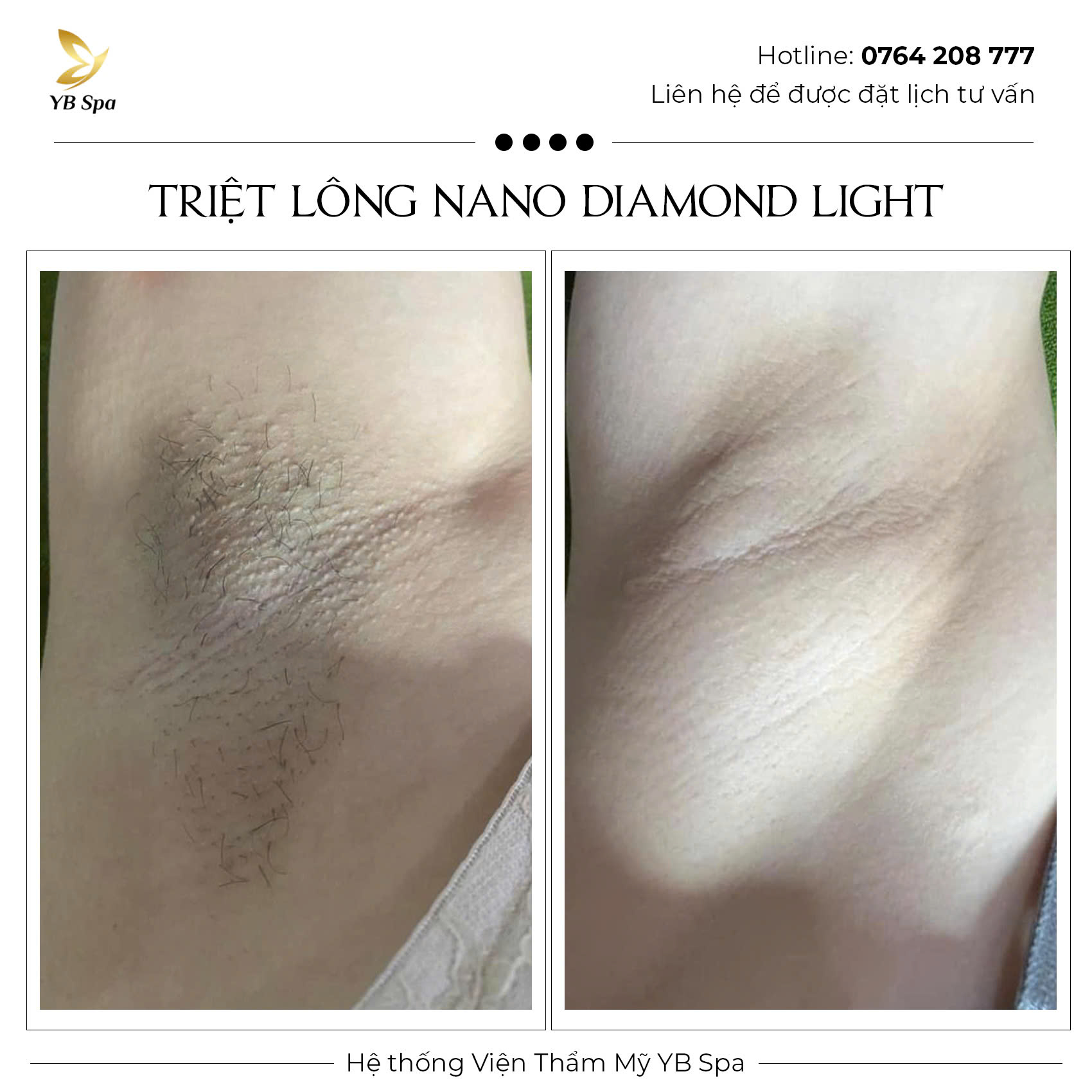 Triệt lông vĩnh viễn NANO DIAMOND LIGHT Hiệu quả 119% 32 Triệt lông vĩnh viễn NANO DIAMOND LIGHT Hiệu quả 119%