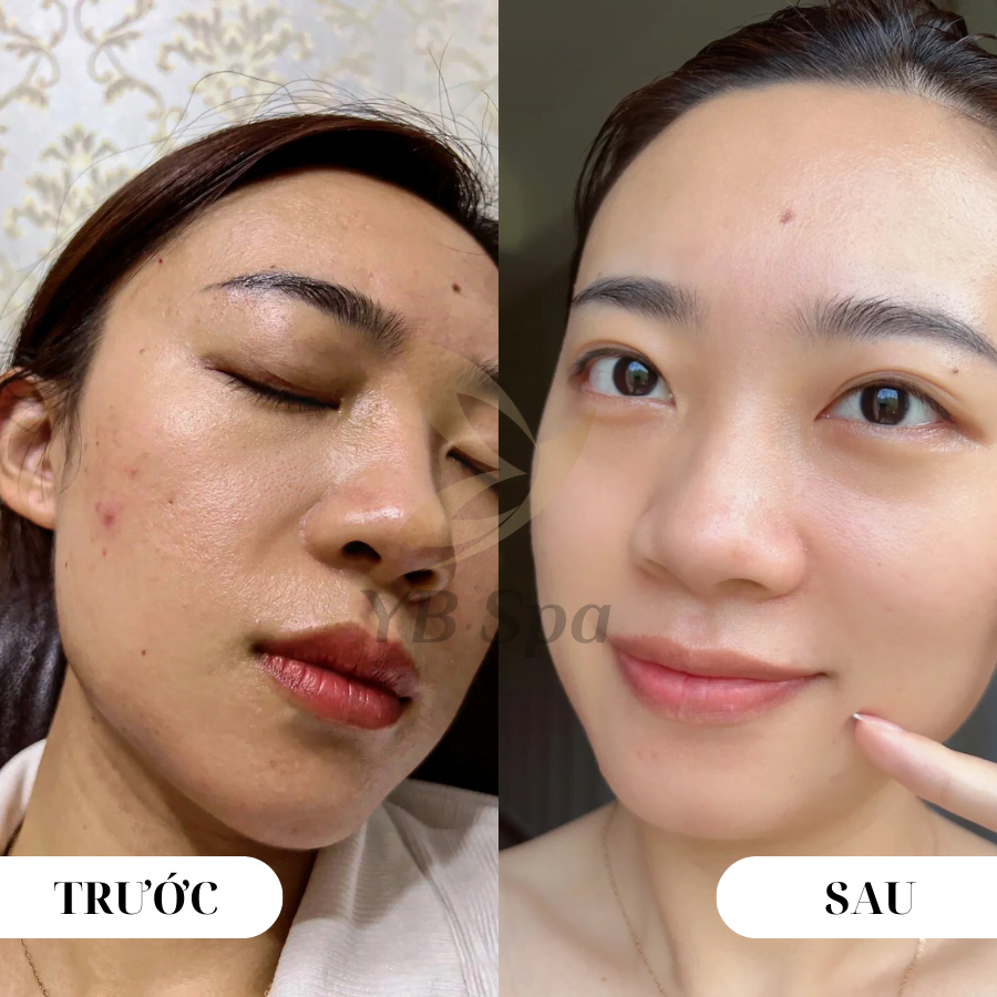 10 cách ngăn mụn tái phát cho tuổi dậy thì 21 tri-mun-chuan-y-khoa