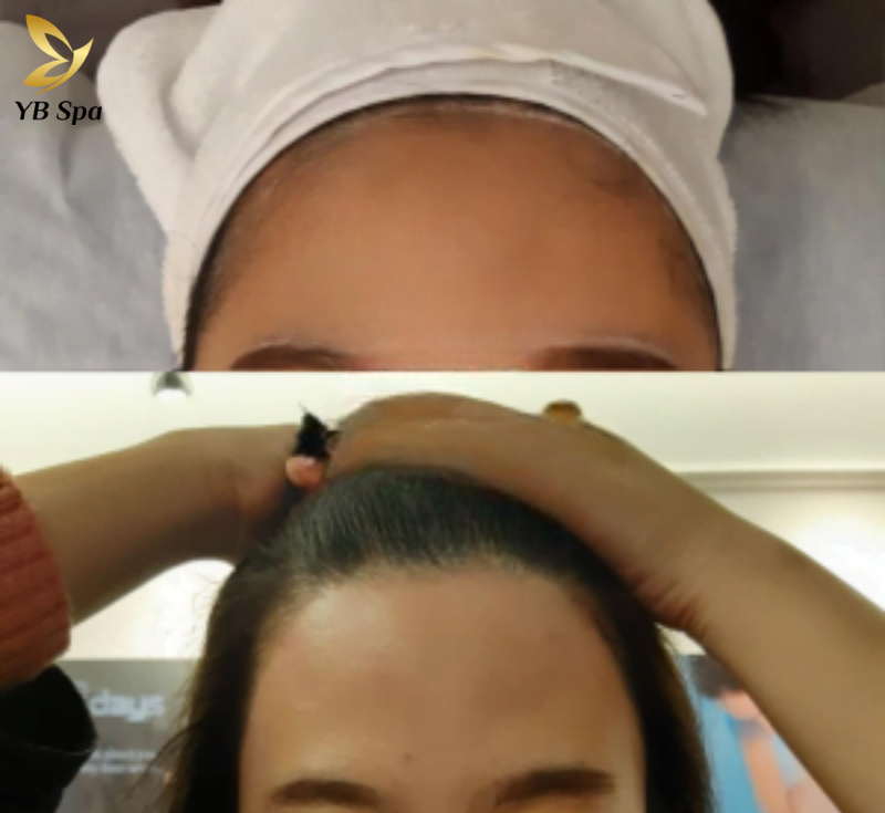 Triệt lông vùng trán HIỆU QUẢ nhất cùng công nghệ SHR ICE2