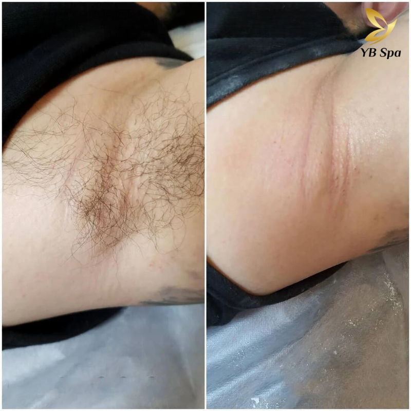 Dịch vụ triệt lông nách UY TÍN công nghệ hiện đại tại YBspa