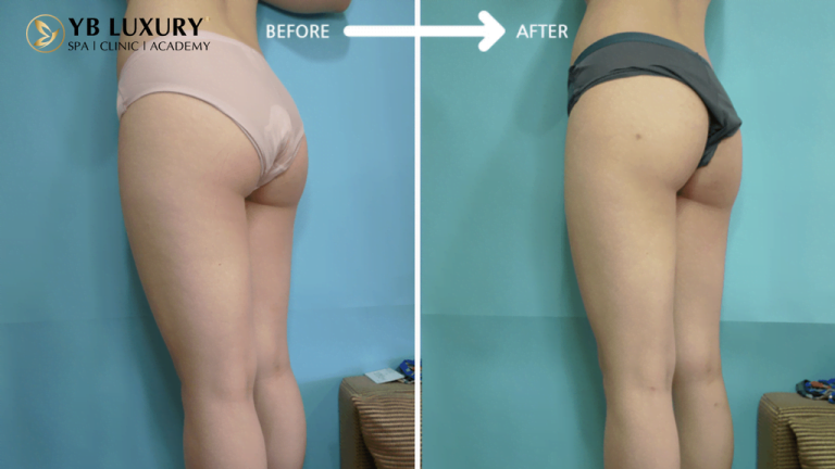 Phương pháp giảm mỡ toàn thân HIỆU QUẢ không phẫu thuật 22 2 768x432