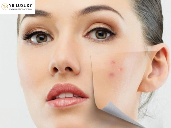 Những vấn đề xuất hiện trên làn da sau sinh