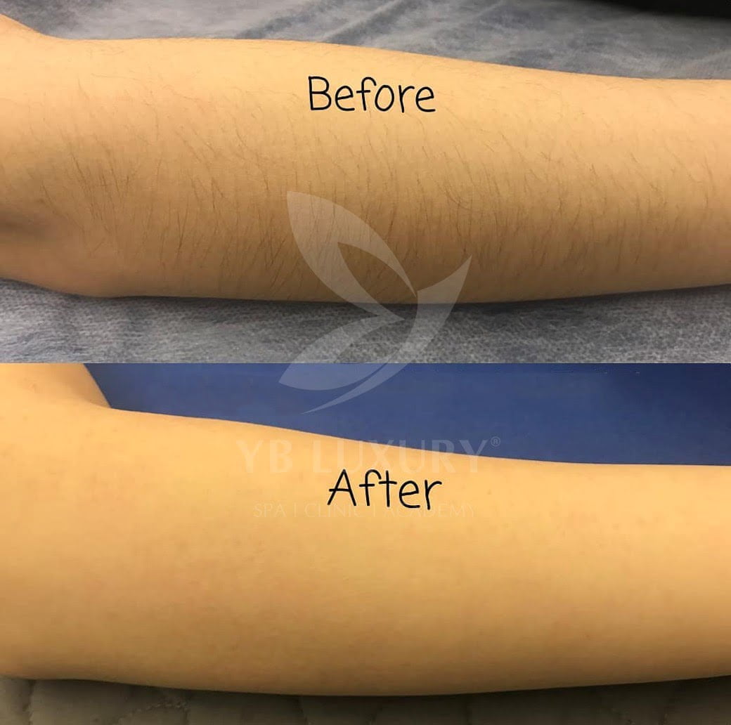 Tay khách hàng sau khi triệt lông tại YB Spa