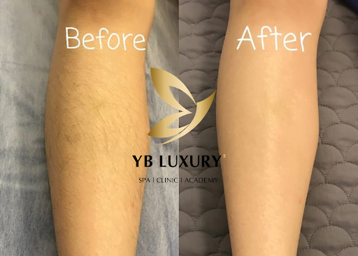 Triệt lông Lathentic hiệu quả chỉ sau một liệu trình