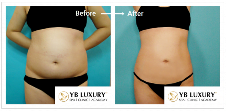 Khách hàng giảm mỡ bụng thành công tại YB Spa