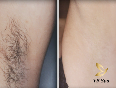 Triệt lông Lathentic ở đâu hiệu quả? 18 Triệt lông bằng công nghệ Lathentic có rất nhiều ưu điểm