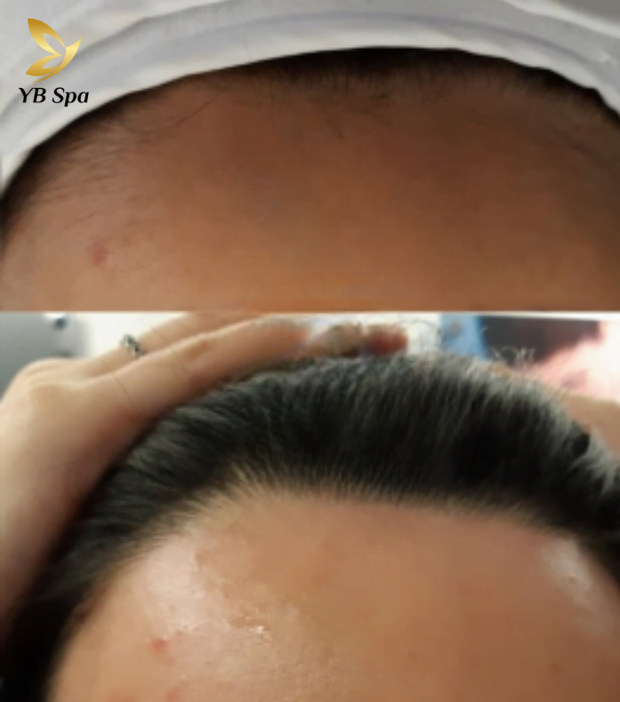 Triệt lông vùng trán HIỆU QUẢ nhất cùng công nghệ SHR ICE2