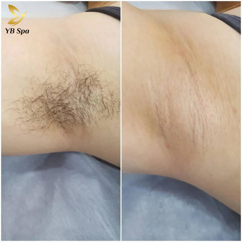 Dịch vụ triệt lông nách UY TÍN công nghệ hiện đại tại YBspa