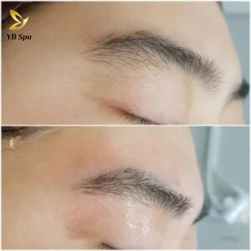 Triệt lông vùng trán HIỆU QUẢ nhất cùng công nghệ SHR ICE2