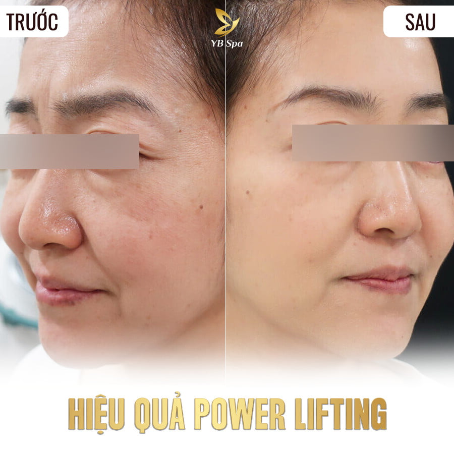 POWER LIFTING - NÂNG CƠ TRẺ HÓA 24 Điều trị mụn trứng cá LÂU NĂM triệt để TẬN GỐC (duplicate)