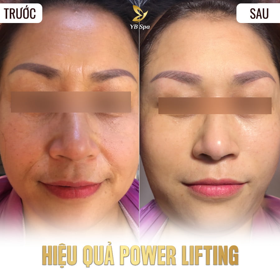 POWER LIFTING - NÂNG CƠ TRẺ HÓA 26 Điều trị mụn trứng cá LÂU NĂM triệt để TẬN GỐC (duplicate)