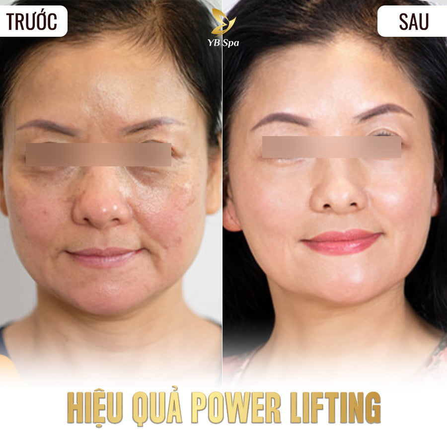 POWER LIFTING - NÂNG CƠ TRẺ HÓA 25 Điều trị mụn trứng cá LÂU NĂM triệt để TẬN GỐC (duplicate)