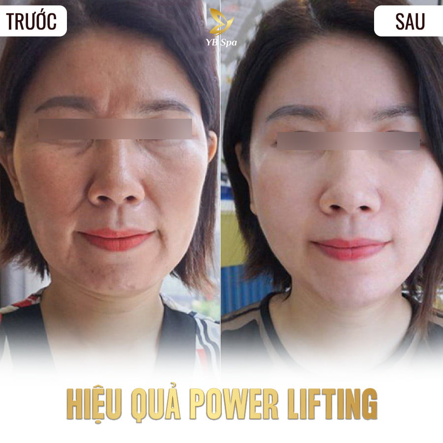 POWER LIFTING - NÂNG CƠ TRẺ HÓA 23 Điều trị mụn trứng cá LÂU NĂM triệt để TẬN GỐC (duplicate)