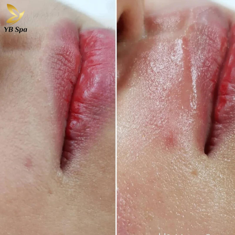 Triệt lông vùng mép bằng công nghệ Nano Diamond Light tại YB Spa 20 Triệt lông vùng mép bằng công nghệ SHR ICE2 hiện đại