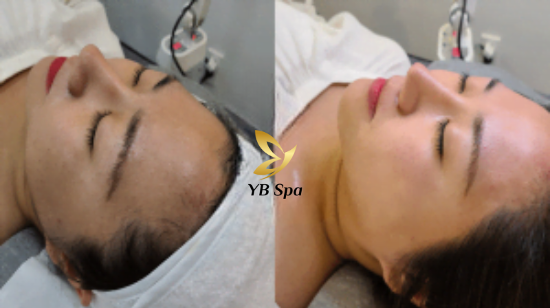 Triệt lông vùng trán HIỆU QUẢ nhất cùng công nghệ SHR ICE2