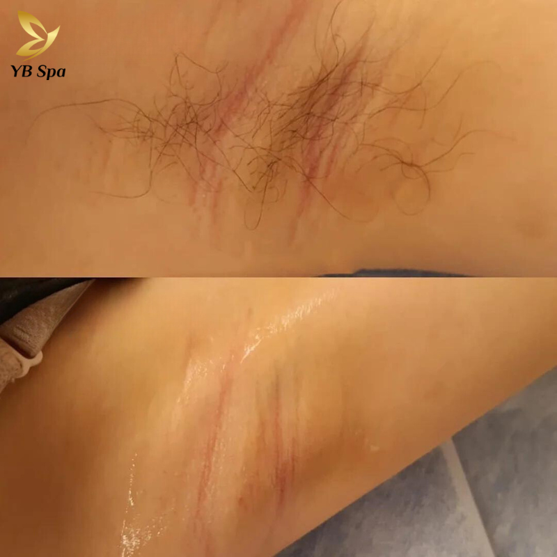 Dịch vụ triệt lông nách UY TÍN công nghệ hiện đại tại YBspa