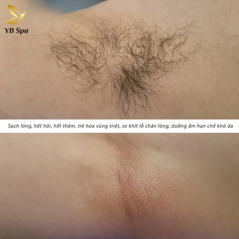 Dịch vụ triệt lông nách UY TÍN công nghệ hiện đại tại YBspa