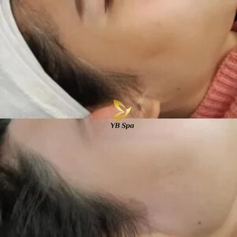 Triệt lông vùng trán HIỆU QUẢ nhất cùng công nghệ SHR ICE2