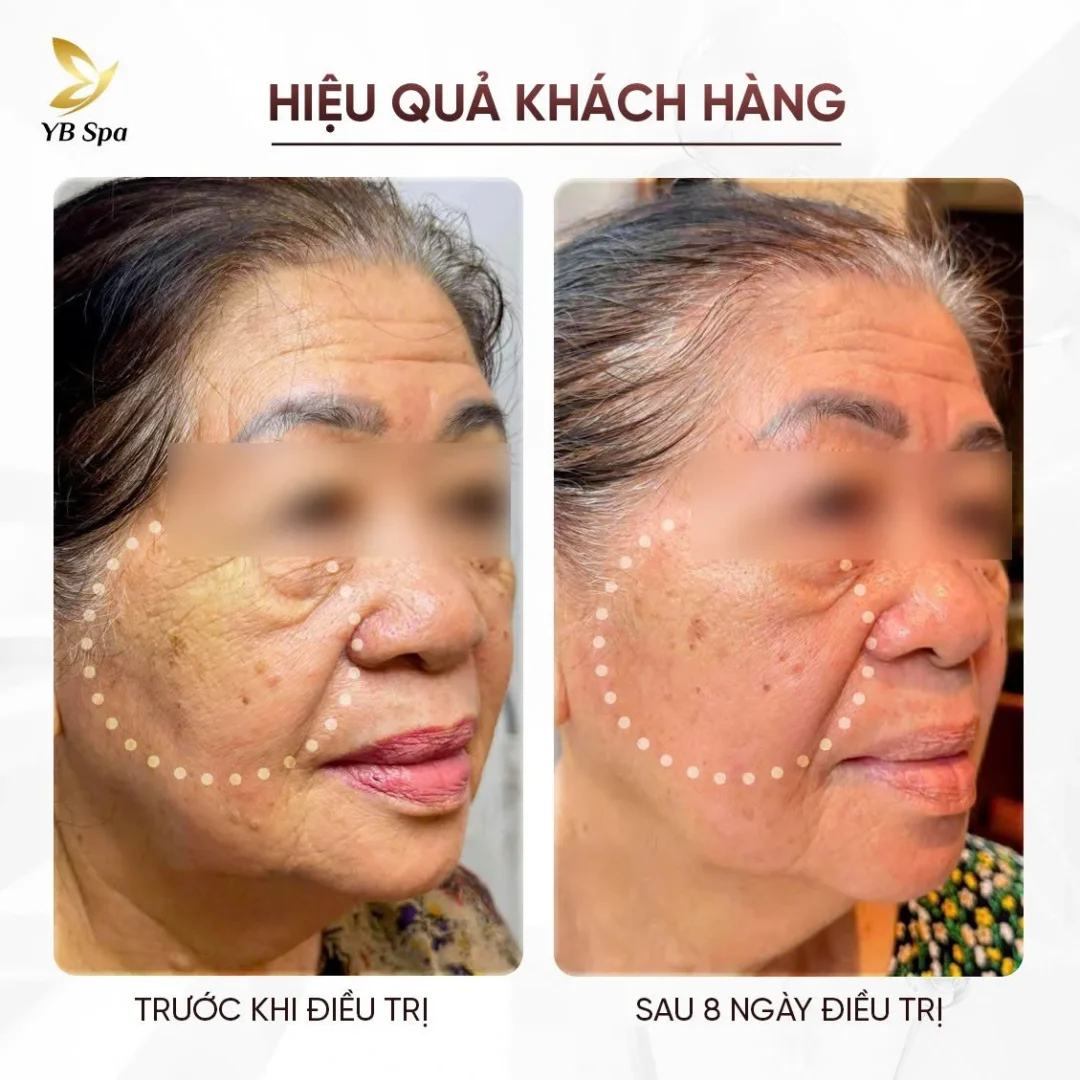 Công Nghệ Density Trẻ Hóa Không Xâm Lấn Được Biểu Tượng Nhan Sắc Hàn Quốc Lee Young Ae Lựa Chọn 10 Công nghệ Density trẻ hóa không xâm lấn được biểu tượng nhan sắc Hàn Quốc Lee Young Ae lựa chọn