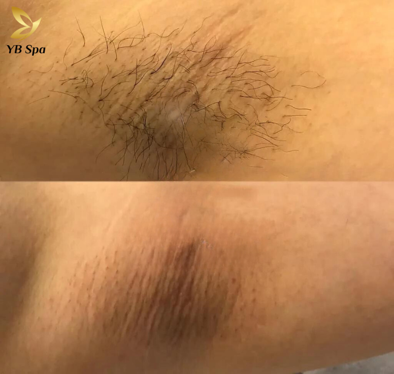 Dịch vụ triệt lông nách UY TÍN công nghệ hiện đại tại YBspa