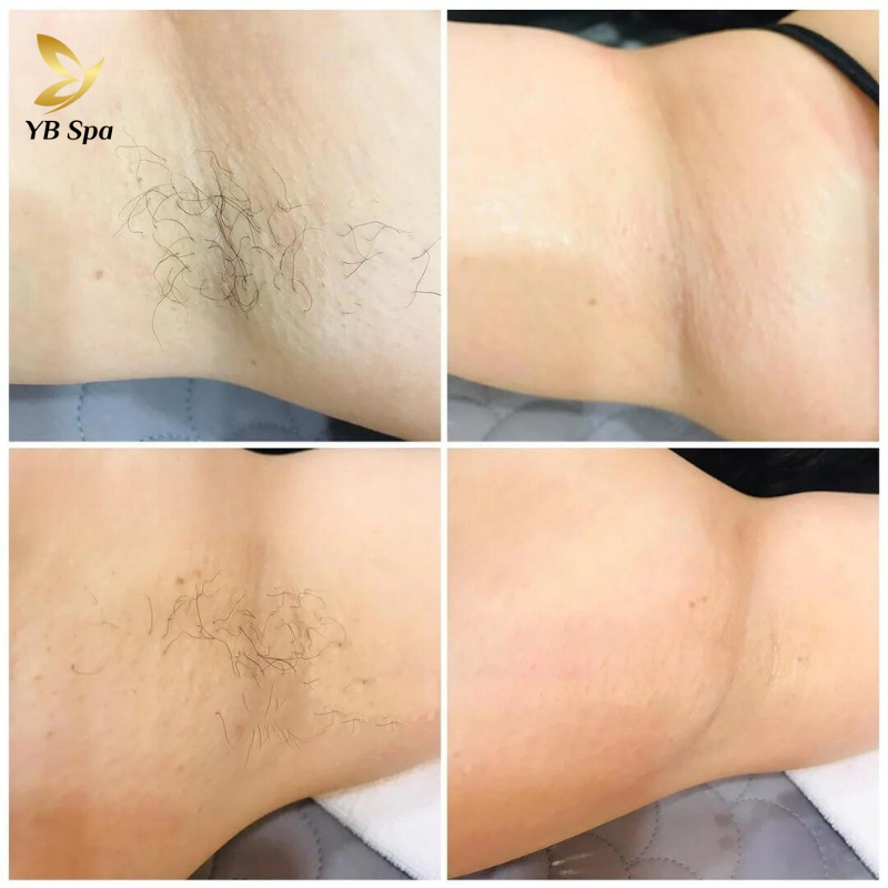 Dịch vụ triệt lông nách UY TÍN công nghệ hiện đại tại YBspa