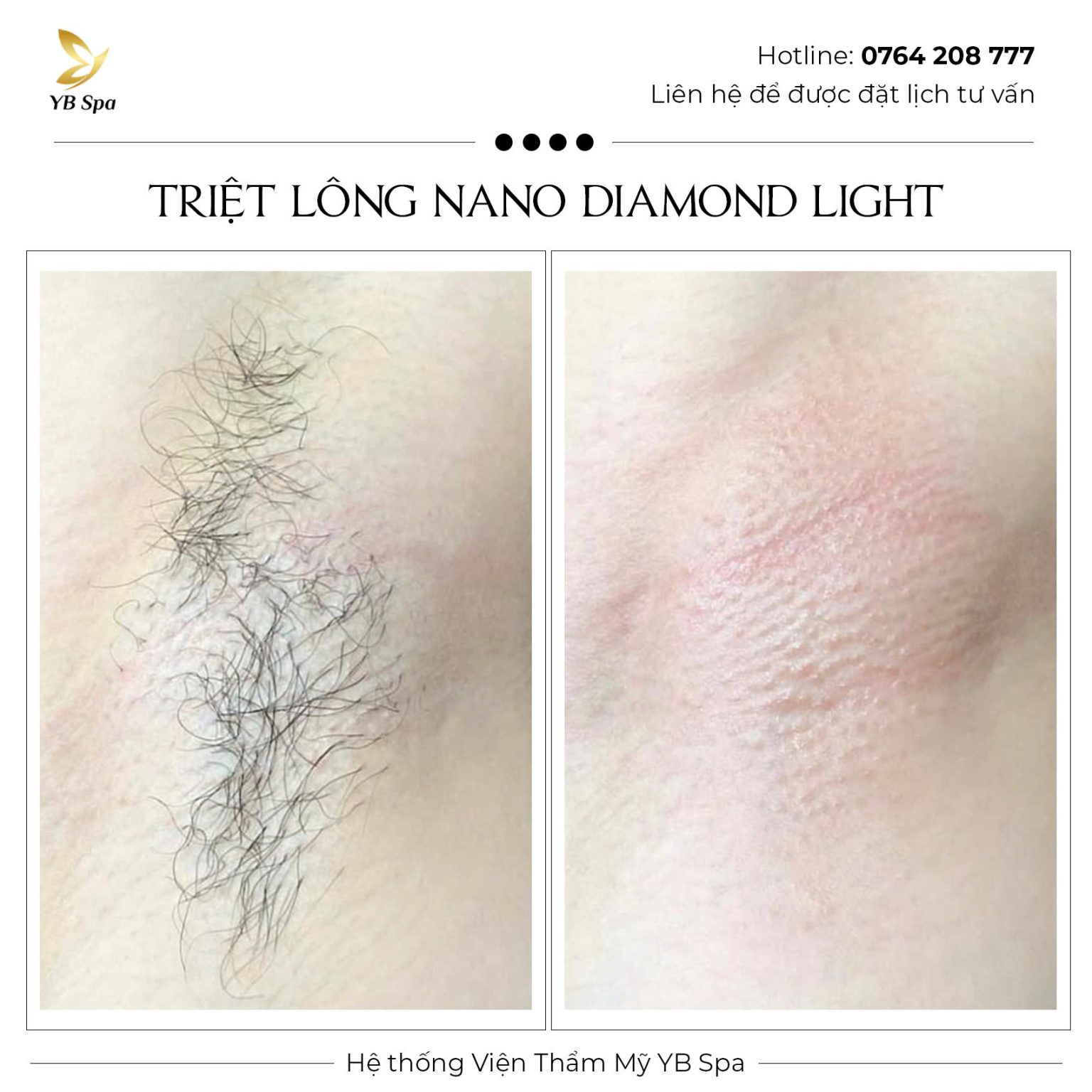 Giá triệt lông vĩnh viễn mới nhất 2026 chỉ từ 290k 32 Kết quả triệt lông nách giúp da sáng mịn và hết viêm nang lông sau liệu trình tại YB Spa.