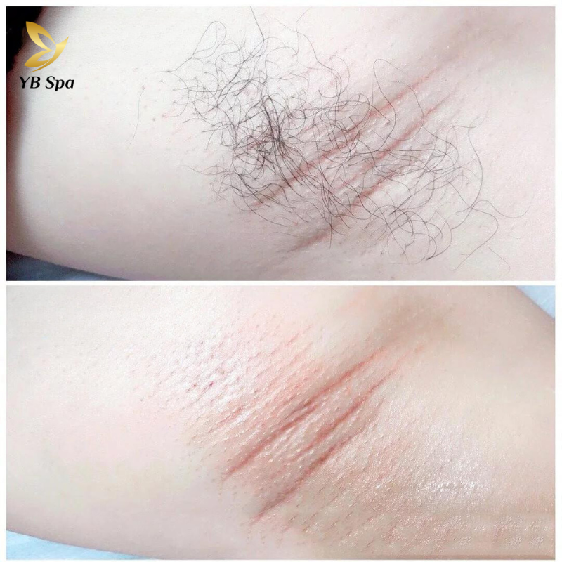Dịch vụ triệt lông nách UY TÍN công nghệ hiện đại tại YBspa
