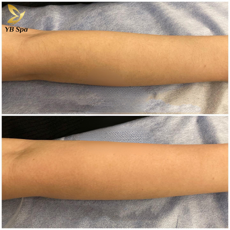 Triệt lông vùng tay AN TOÀN với công nghệ SHR ICE2