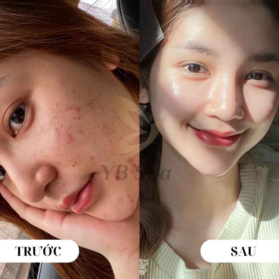 Sự thật về tác động của meso extra lên làn da 17 cong-dung-cay-meso