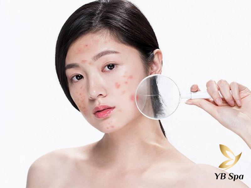 Ăn dưa hấu có nổi mụn không? Cách ăn dưa hấu không nổi mụn 24 Dưa hấu có chứa lycopene là thành phần giúp ngăn ngừa lão hóa và giúp làn da căng mọng, tươi trẻ