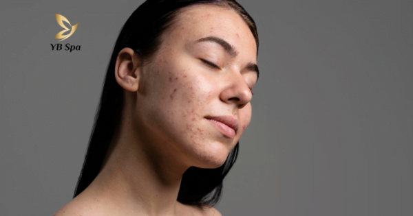 nguyen-nhan-gay-mun-trung-ca