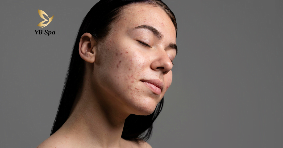 nguyen-nhan-gay-mun-trung-ca