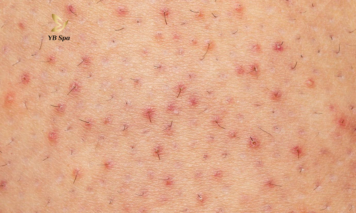 trieu-chung-long-moc-nguoc