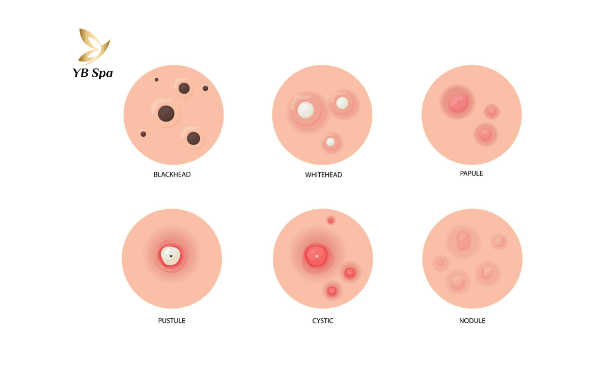 phan-biet-cac-loai-mun-trung-ca