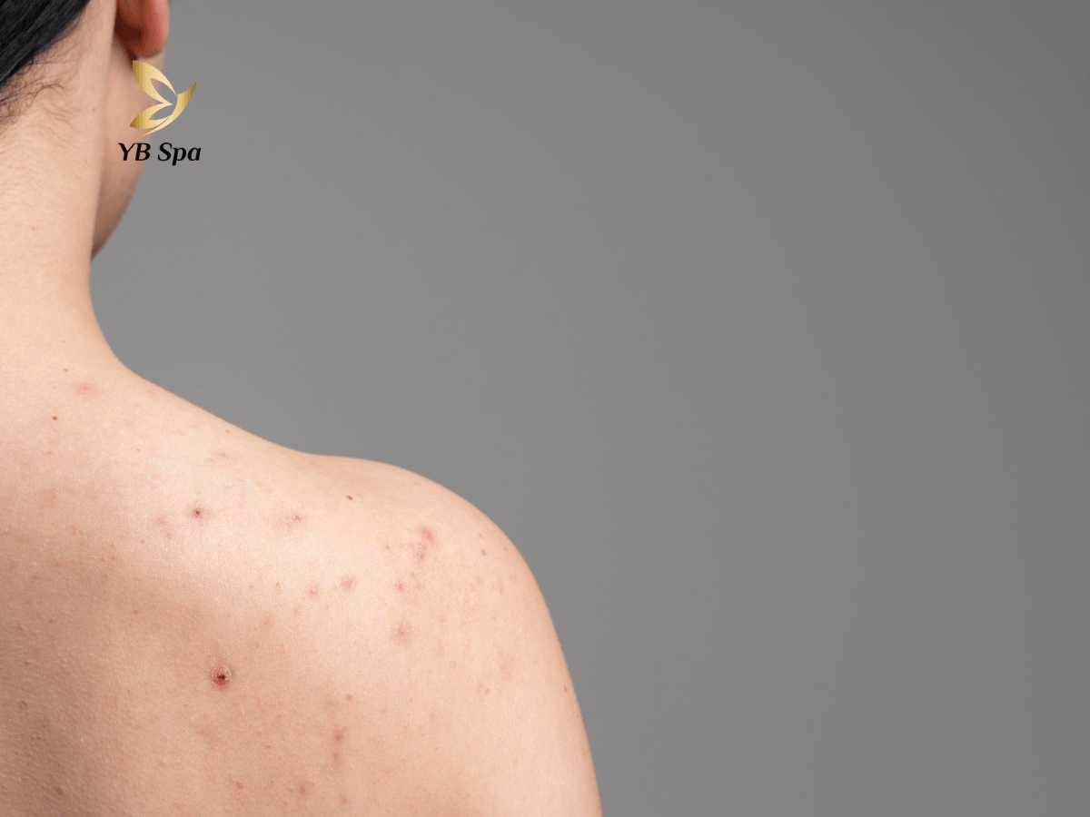 Nguyen-nhan-mun-lung