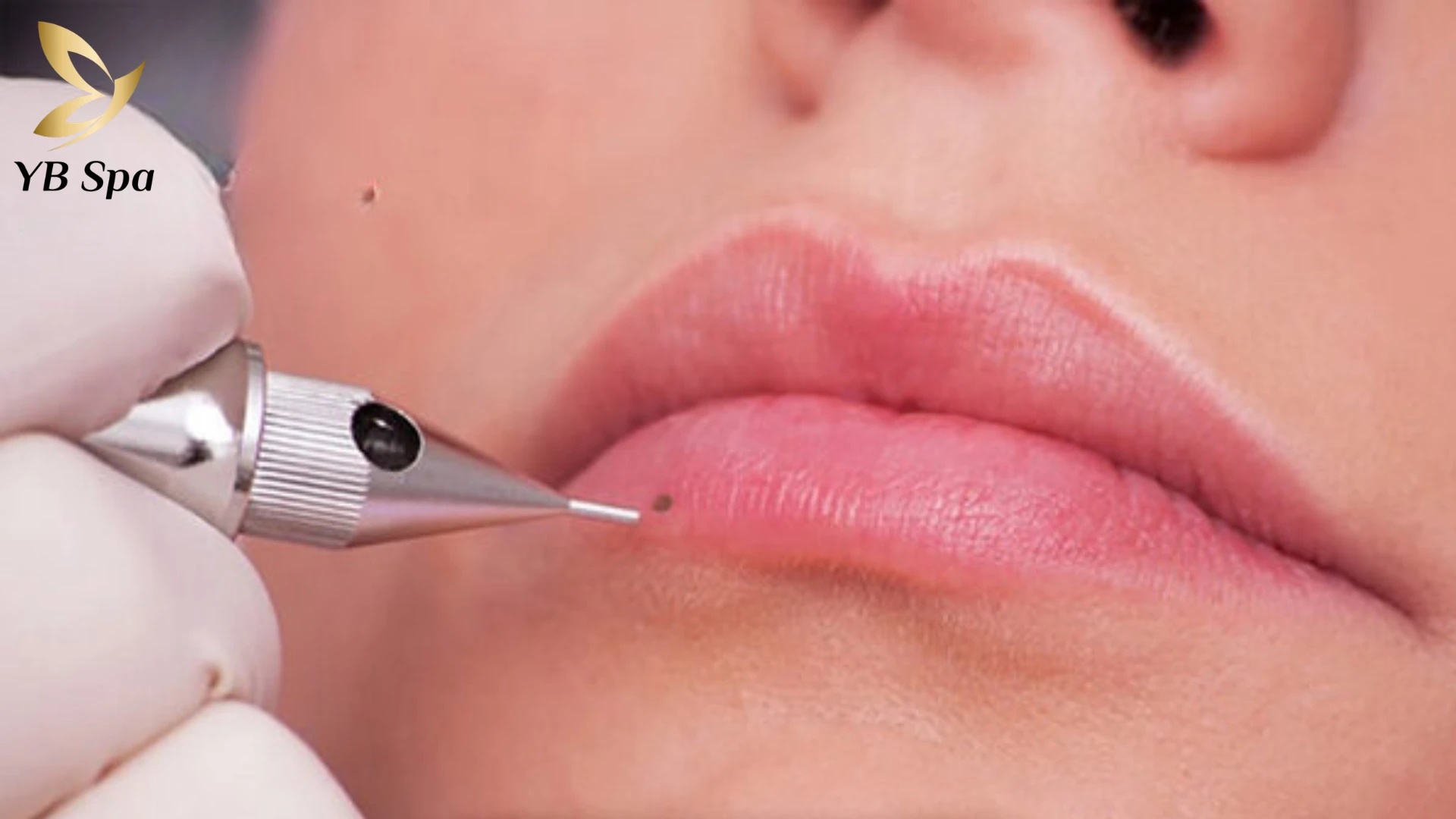 Tham khảo ý kiến chuyên gia để lựa chọn phương pháp tẩy nốt ruồi an toàn, hiệu quả.