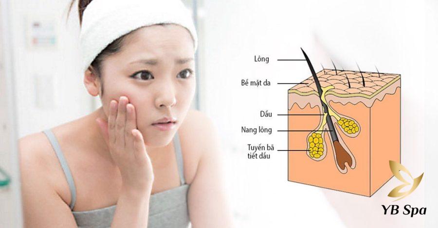 Hình ảnh nguyên nhân tạo ra mụn