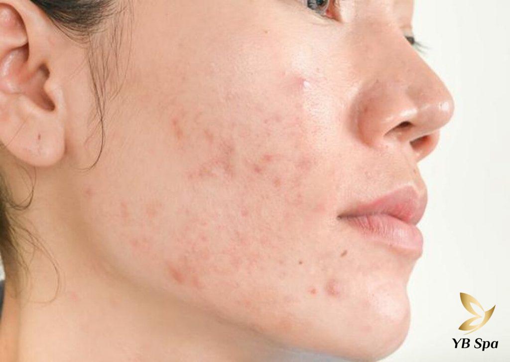 Tại sao triệt lông mặt lại nổi mụn? Có nên triệt lông mặt? 21 Hình ảnh bị mụn sau khi triệt lông mặt