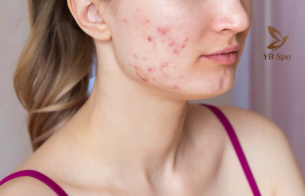 MỤN VIÊM ĐỎ KHÔNG CÒN LÀ NỖI ÁM ẢNH NẾU BẠN BIẾT NHỮNG ĐIỀU NÀY