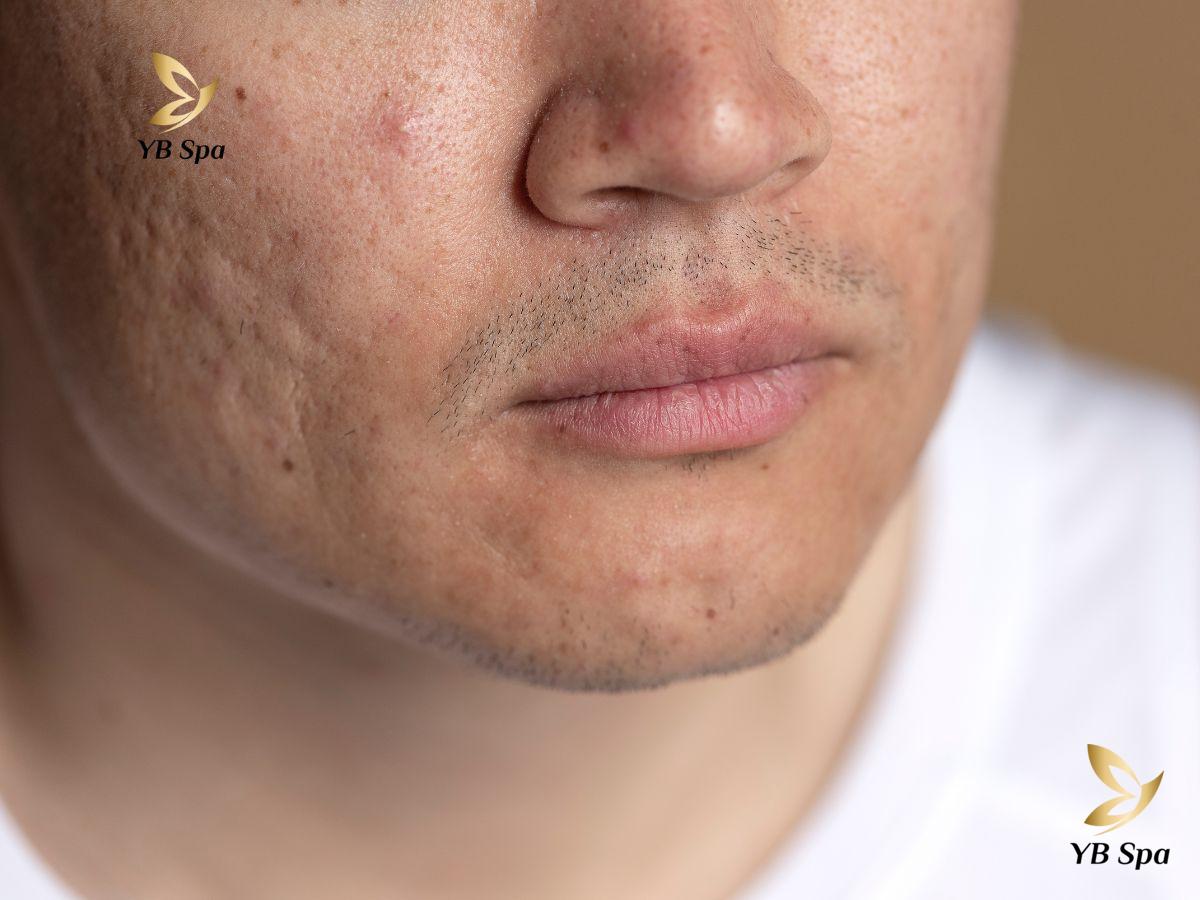 triệt lông mặt có thể để lại sẹo