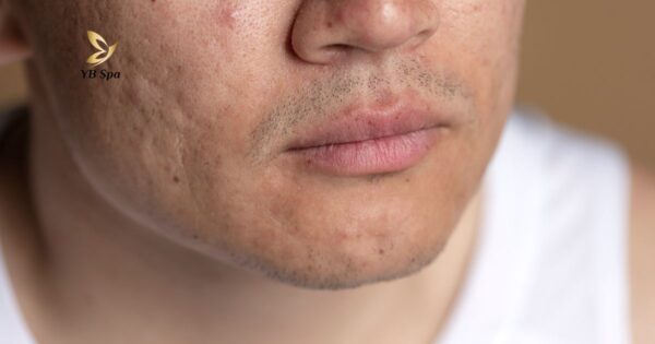 triệt lông mặt có để lại sẹo không